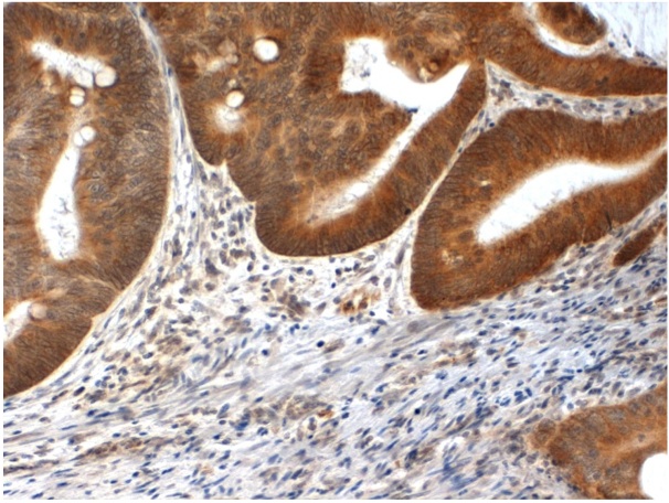 Immunohistochemical staining of FFPE human colon carcinoma tissue using PINK-1 (NT) antibody (Cat. No. X2759P).  Antibody used at 1 µg/ml and visualized using DAB.  Pathologists Comments: Cytoplasmic and partial nuclear staining of mucous cells.